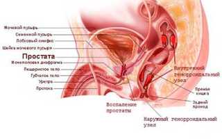 Влияет ли геморрой на мужскую потенцию и здоровье?