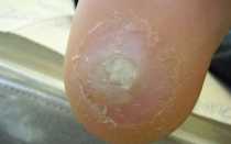 Следи за ногами. 10 признаков болезней, которые нельзя упустить