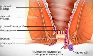 Мужской геморрой: причины и лечение
