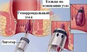 Чем можно лечить геморройные узлы в домашних условиях