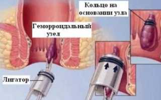 Чем можно лечить геморройные узлы в домашних условиях