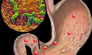 Как лечить гастродуоденит у взрослых лекарствами эффективно и безопасно
