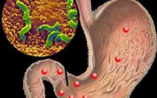 Как лечить гастродуоденит у взрослых лекарствами эффективно и безопасно