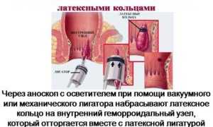 Как лечить внутренний геморрой: советы и рекомендации