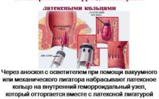 Как лечить внутренний геморрой: советы и рекомендации