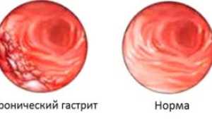 Хеликобактер пилори и сыпь на коже: причины и лечение
