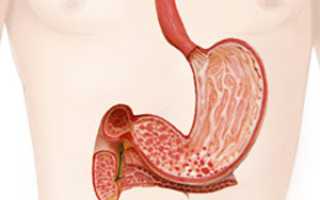 Гастродуоденит катаральный, острый: симптомы и лечение