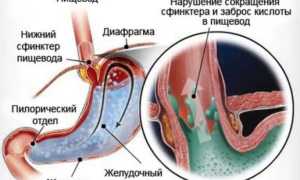 Эзофагит фибринозный: причины и лечение