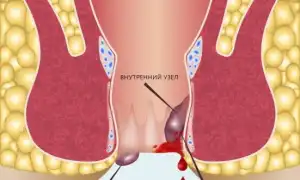 Что делать, когда кровь при геморрое: советы и рекомендации