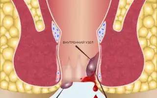 Что делать, когда кровь при геморрое: советы и рекомендации