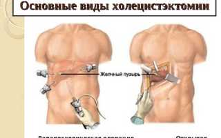 Хологенная диарея: причины и лечение