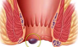 Шишки геморроя: причины и лечение