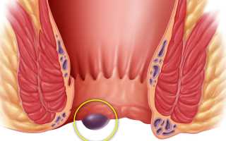 Шишки геморроя: причины и лечение