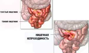 Острая кишечная непроходимость: причины и симптомы