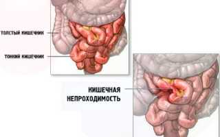 Острая кишечная непроходимость: причины и симптомы
