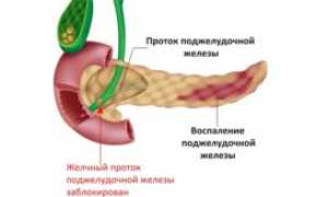 Хроническая диарея: причины и лечение