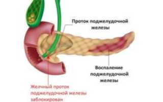 Хроническая диарея: причины и лечение