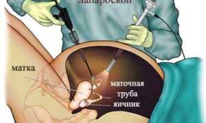 Вздутие живота после ЭКО, переноса эмбрионов: причины и решения