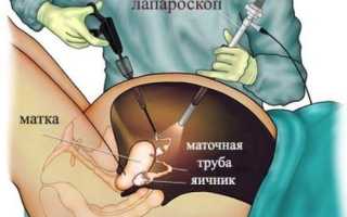 Вздутие живота после ЭКО, переноса эмбрионов: причины и решения