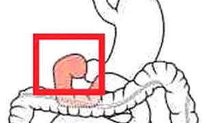 Бульбит катаральный: симптомы и лечение