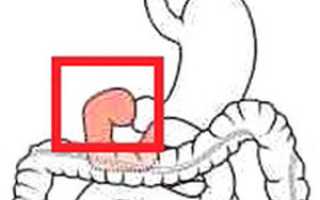 Бульбит катаральный: симптомы и лечение