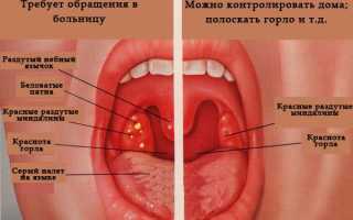 Боли в горле после гастроскопии, что делать для облегчения