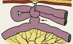 Странгуляционная непроходимость кишечника: причины и лечение