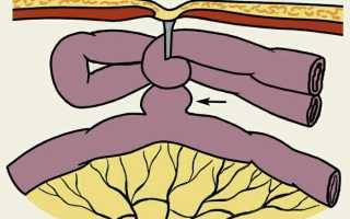 Странгуляционная непроходимость кишечника: причины и лечение