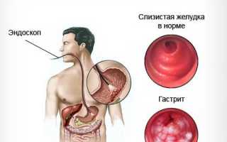 Неприятный запах изо рта при гастрите: причины и решения