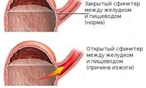 Таблетки для устранения изжоги у беременных женщин