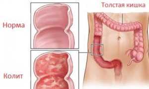 Диетическое питание при колите кишечника и запорах для здоровья