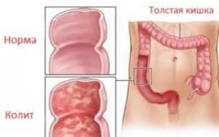 Диетическое питание при колите кишечника и запорах для здоровья