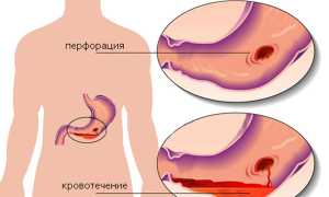 Кровотечение при язвенной болезни желудка: причины и лечение