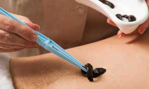 Пиявки для лечения геморроя: эффективный метод терапии