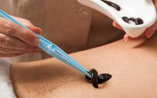 Пиявки для лечения геморроя: эффективный метод терапии