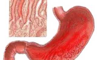 Диета при острой форме гастрита для быстрого выздоровления