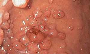 Гастрит зернистый: причины и симптомы