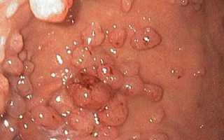 Гастрит зернистый: причины и симптомы