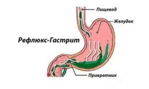 Рефлюксный тип гастрита: причины и симптомы