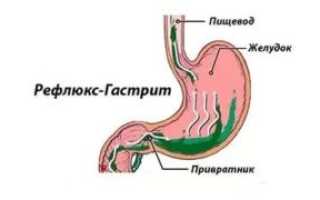 Рефлюксный тип гастрита: причины и симптомы