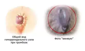 Тромбоз геморроидальных вен и узлов: причины и лечение