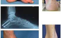 Упражнения для подъема стопы