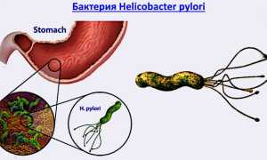 Хеликобактерный тип гастрита: причины и лечение