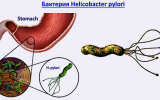 Хеликобактерный тип гастрита: причины и лечение