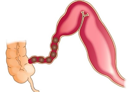 Странгуляционная кишечная непроходимость