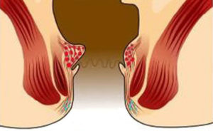 начальная стадия геморроя