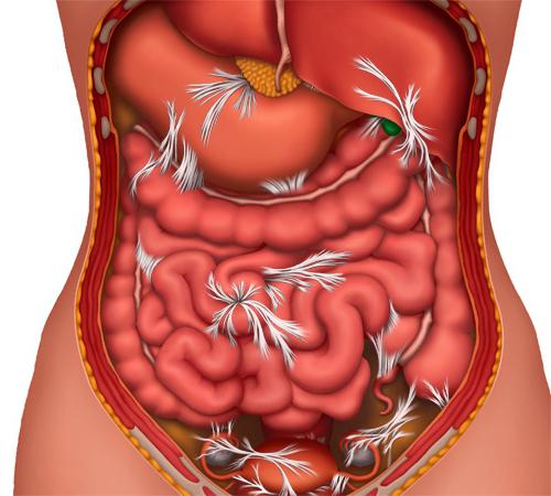 кишечная непроходимость