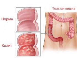 колит