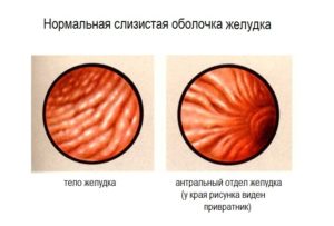 Нормальная слизистая