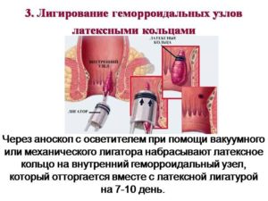 Лигирование узлов